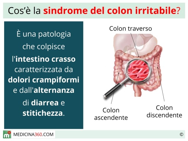 Sindrome del colon irritabile