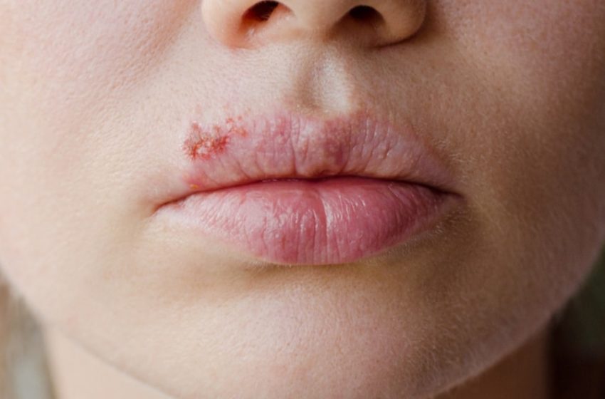  Herpes Zoster: cos’è e come si cura