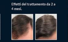  Follixin funziona contro la caduta dei capelli?